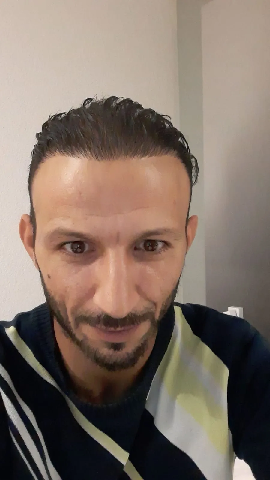FUE — Sonrası