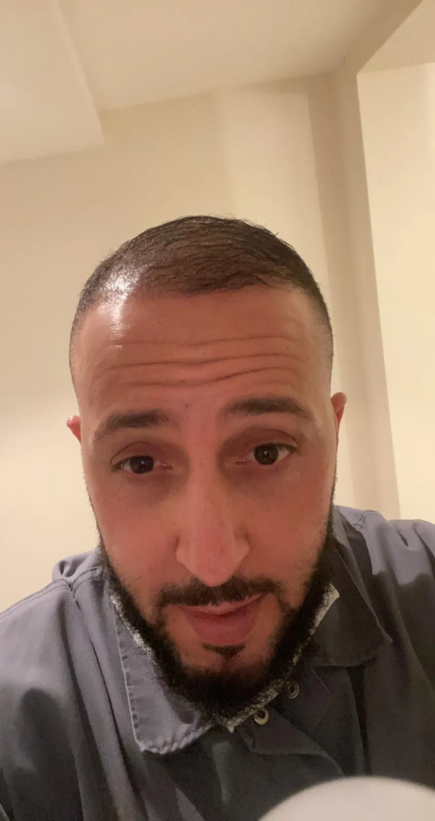 FUE — Sonrası