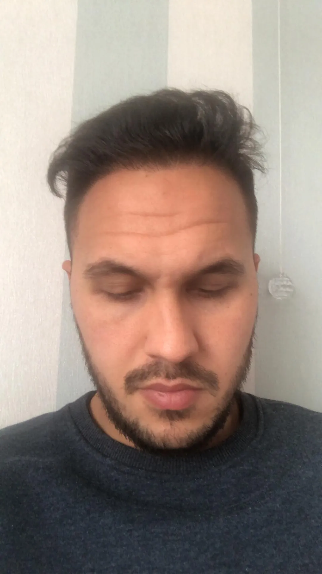Safir FUE — Sonrası