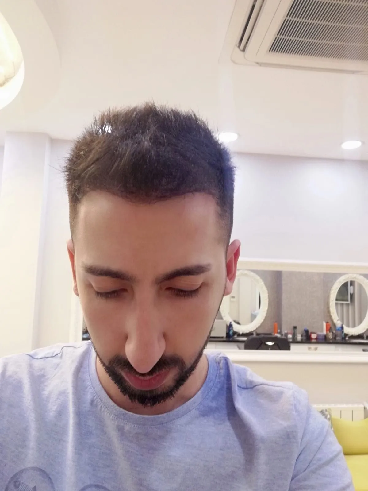 FUE — Sonrası