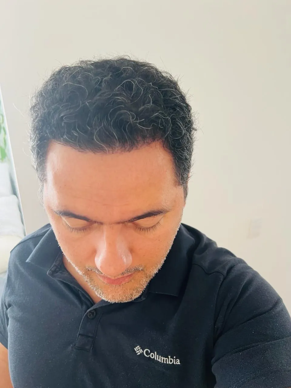 FUE — Sonrası