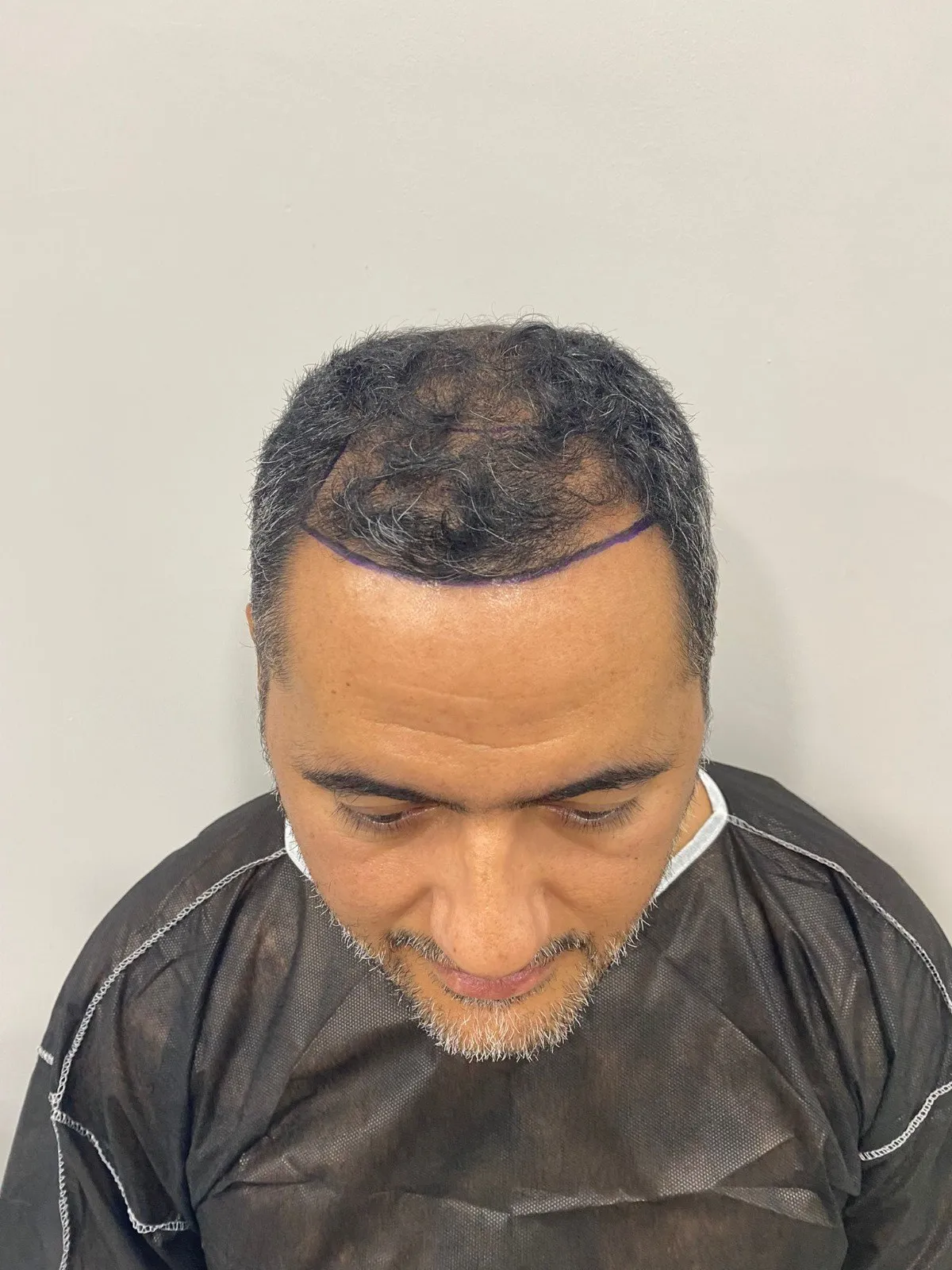 FUE — Öncesi