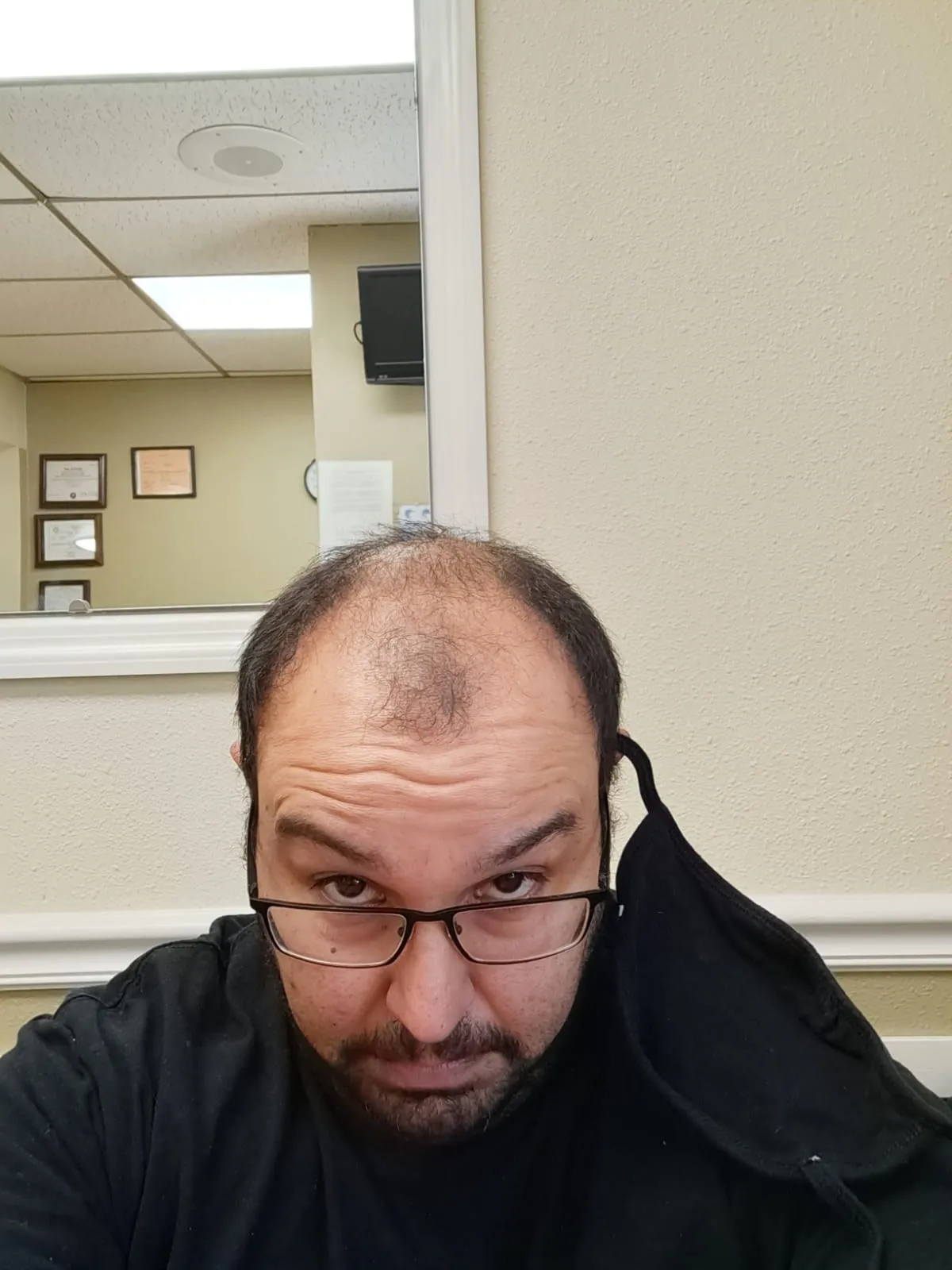 FUE — Öncesi
