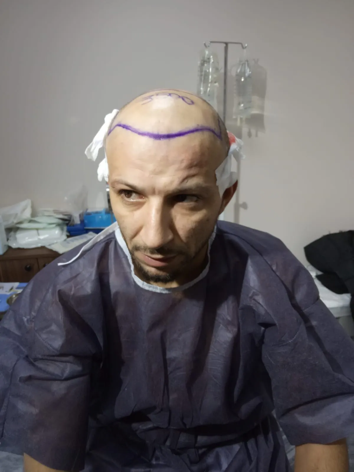 FUE — Öncesi