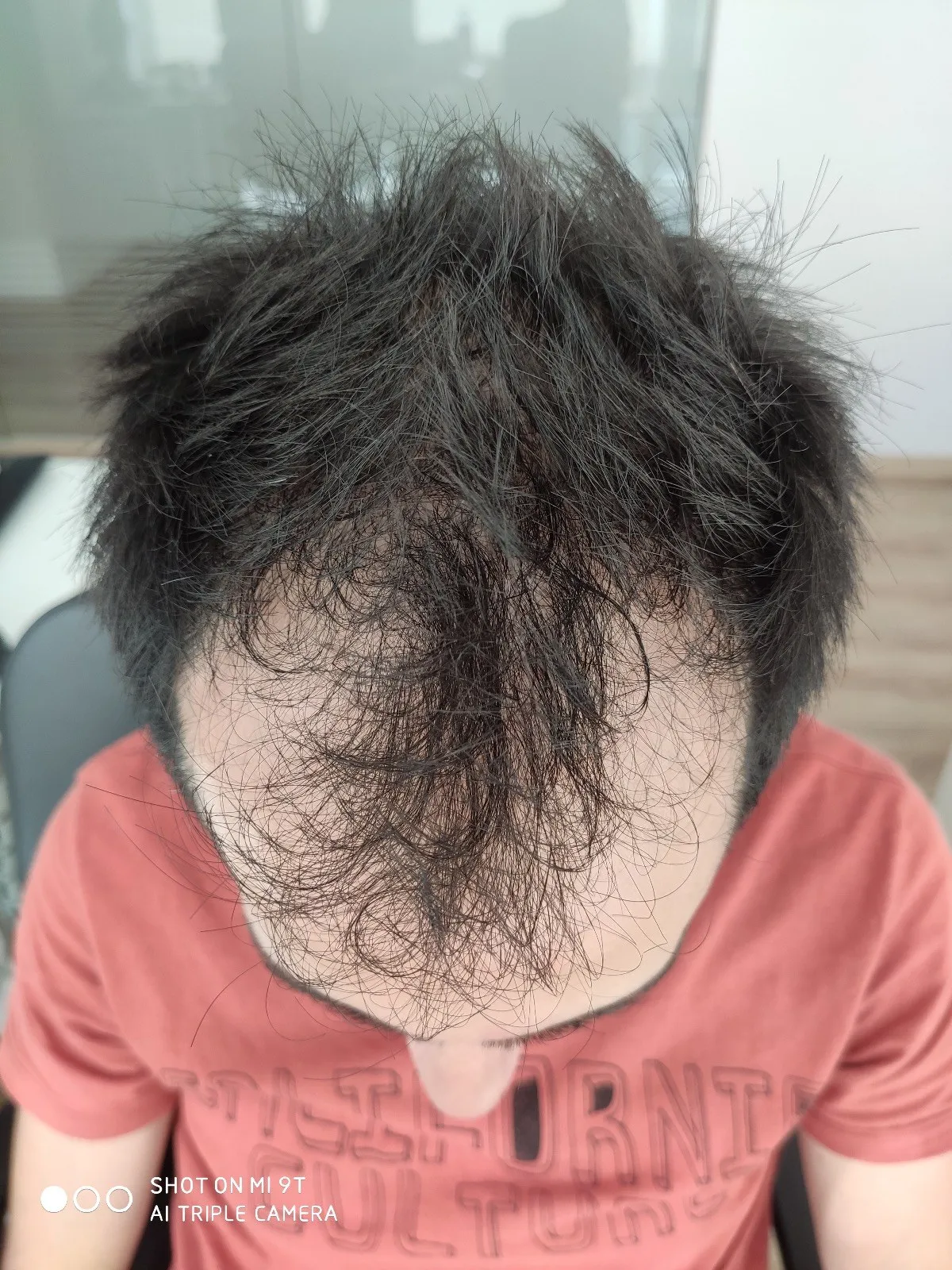 FUE — Öncesi