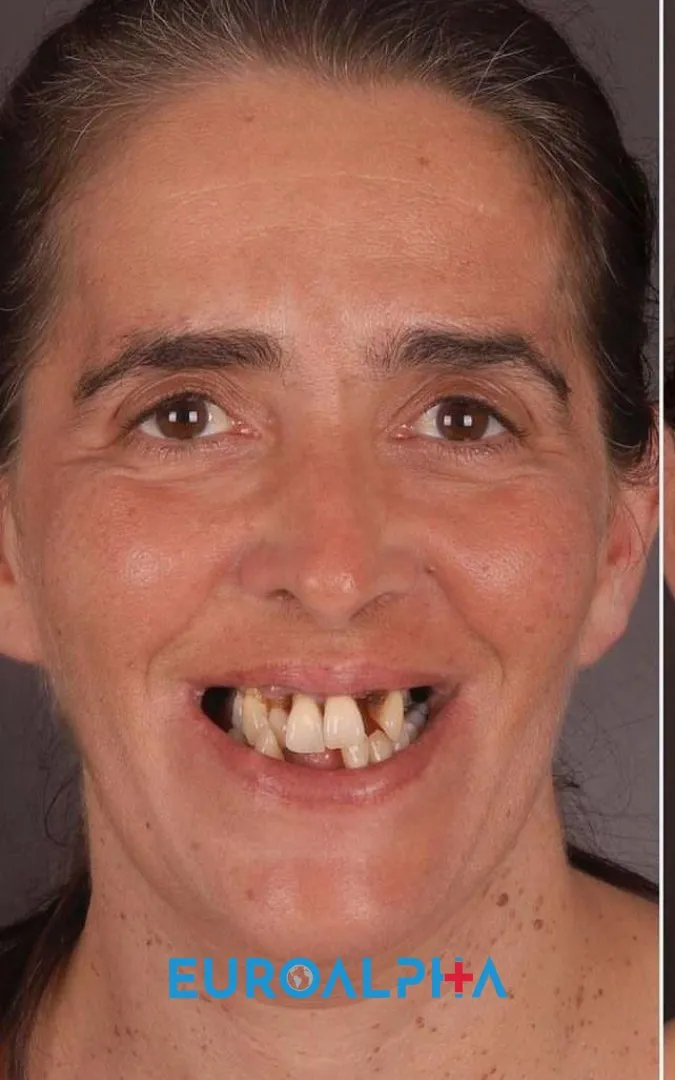 Diş implantı — Öncesi